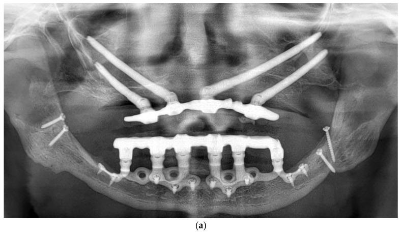 https://cdn.ncbi.nlm.nih.gov/pmc/blobs/55ba/12384704/50b93f1fda75/dentistry-13-00337-g006a.jpg