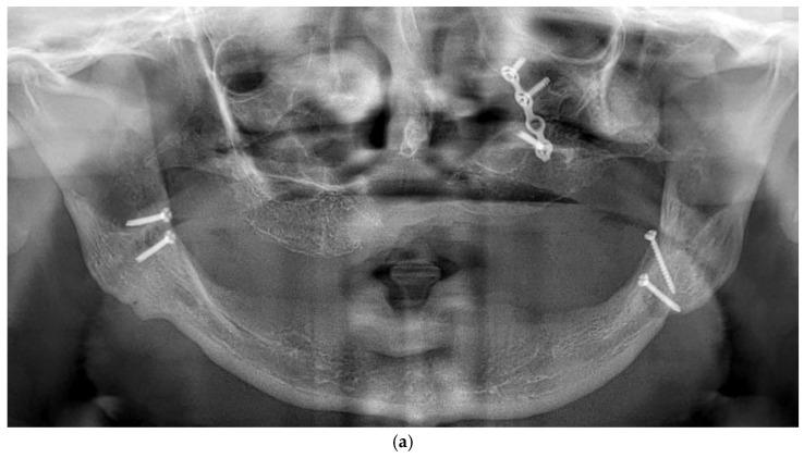 https://cdn.ncbi.nlm.nih.gov/pmc/blobs/55ba/12384704/c5f0e135f198/dentistry-13-00337-g002a.jpg