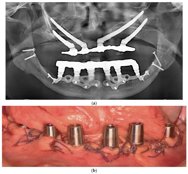 https://cdn.ncbi.nlm.nih.gov/pmc/blobs/55ba/12384704/d89026713757/dentistry-13-00337-g005.jpg