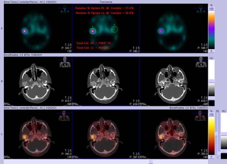 https://cdn.ncbi.nlm.nih.gov/pmc/blobs/55ba/8616029/8bcd08b65cad/cureus-0013-00000019059-i06.jpg