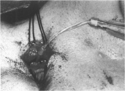https://cdn.ncbi.nlm.nih.gov/pmc/blobs/55d3/505195/baaf2796a282/brjopthal00019-0043-a.jpg
