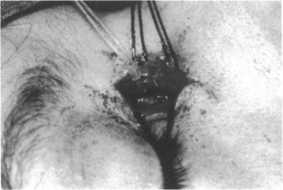 https://cdn.ncbi.nlm.nih.gov/pmc/blobs/55d3/505195/eb498108ca34/brjopthal00019-0042-a.jpg