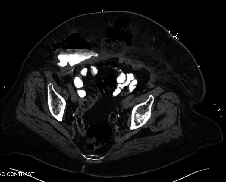 https://cdn.ncbi.nlm.nih.gov/pmc/blobs/565c/10305508/624bbc6fa4c7/cureus-0015-00000039635-i02.jpg