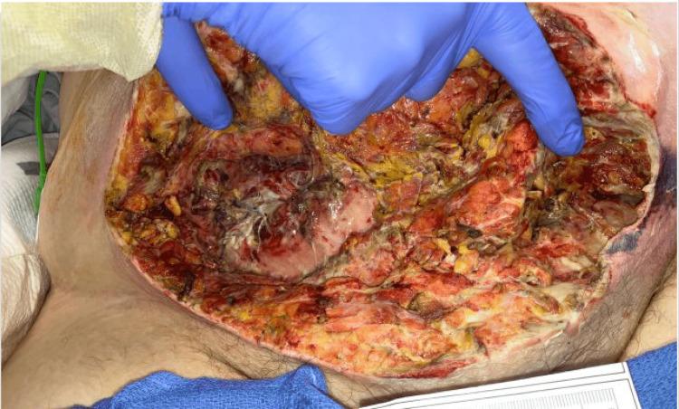 https://cdn.ncbi.nlm.nih.gov/pmc/blobs/565c/10305508/ecd799ed503a/cureus-0015-00000039635-i03.jpg