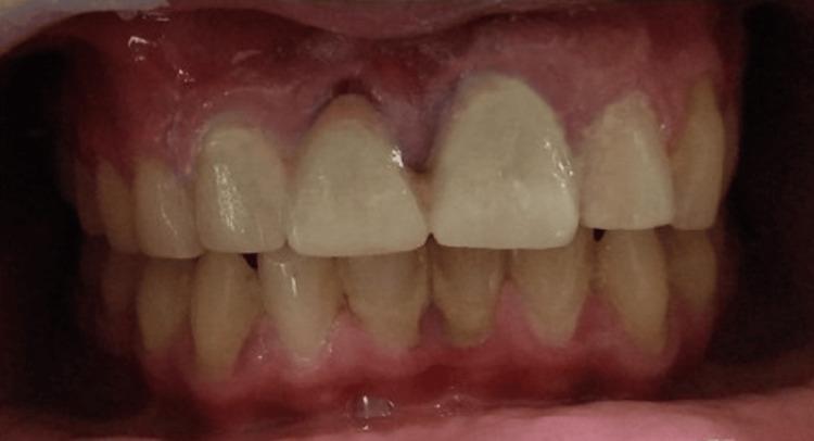 https://cdn.ncbi.nlm.nih.gov/pmc/blobs/5681/10882953/92eba5651a64/cureus-0016-00000052785-i08.jpg