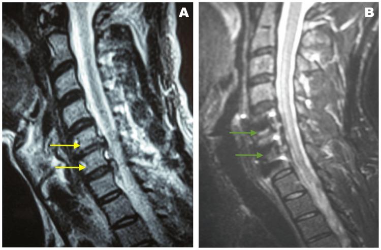 https://cdn.ncbi.nlm.nih.gov/pmc/blobs/5686/11132310/448b33e7f59a/cureus-0016-00000059217-i01.jpg