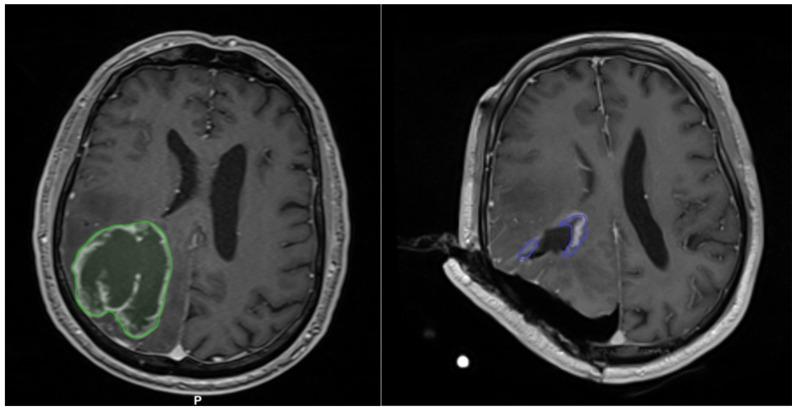 https://cdn.ncbi.nlm.nih.gov/pmc/blobs/56aa/9498154/2ff337ee649c/curroncol-29-00518-g011.jpg