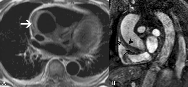 https://cdn.ncbi.nlm.nih.gov/pmc/blobs/56cb/3137850/248ab667fc99/IJRI-21-124-g012.jpg