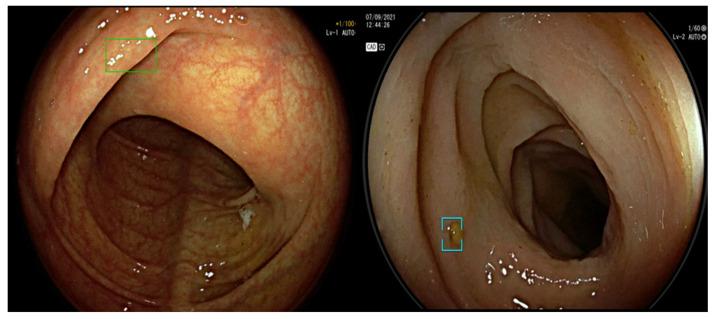 https://cdn.ncbi.nlm.nih.gov/pmc/blobs/57c6/10047293/90f51b419067/diagnostics-13-01102-g004.jpg