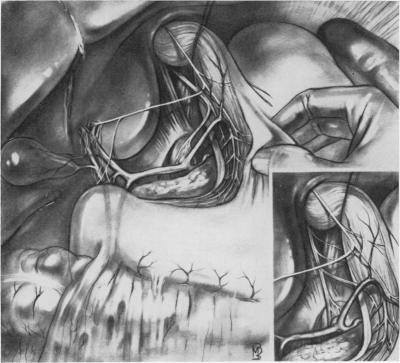 https://cdn.ncbi.nlm.nih.gov/pmc/blobs/57fa/1408393/3c5cfc47baeb/annsurg00950-0136-a.jpg