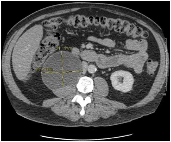 https://cdn.ncbi.nlm.nih.gov/pmc/blobs/5801/5433670/cf952b134420/10.1177_2050313X17700745-fig2.jpg