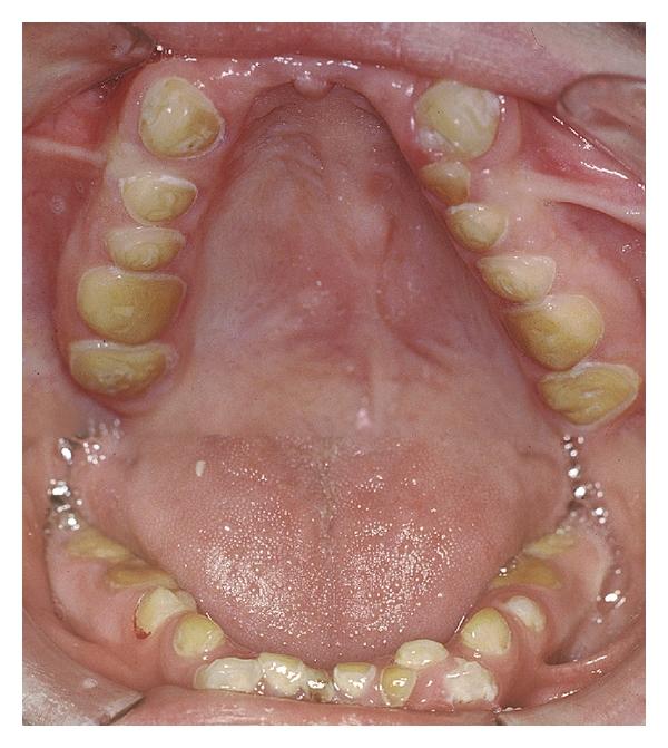 https://cdn.ncbi.nlm.nih.gov/pmc/blobs/580e/3312266/10ef40e37449/IJD2012-632907.007.jpg