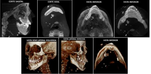 https://cdn.ncbi.nlm.nih.gov/pmc/blobs/584e/10919838/5481897f0b5f/odontologica-9-04-e086-gf1.jpg