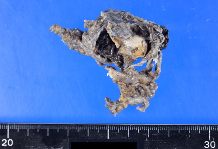 https://cdn.ncbi.nlm.nih.gov/pmc/blobs/5857/11788454/47ec2ab76a1d/cureus-0017-00000076849-i01.jpg