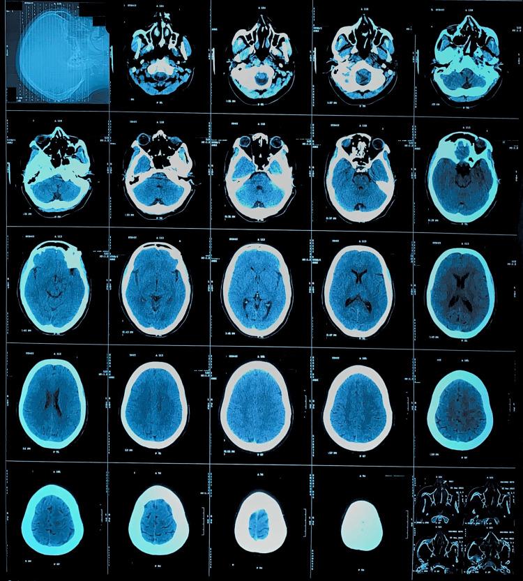 https://cdn.ncbi.nlm.nih.gov/pmc/blobs/5862/11076926/ac9a573c78d9/cureus-0016-00000057790-i01.jpg