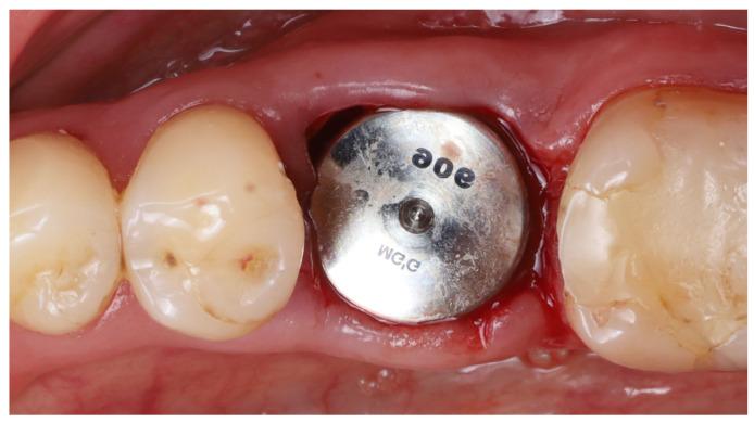 https://cdn.ncbi.nlm.nih.gov/pmc/blobs/58f6/12025736/a147a61e8b8b/dentistry-13-00145-g005.jpg