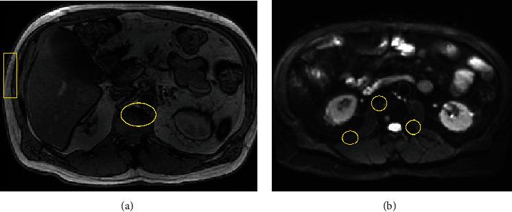 https://cdn.ncbi.nlm.nih.gov/pmc/blobs/5918/11444798/37c0fc343c44/CRIONM2024-8870681.001.jpg