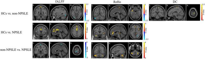 https://cdn.ncbi.nlm.nih.gov/pmc/blobs/5983/9108669/e119829ef6fa/fnins-16-839194-g002.jpg