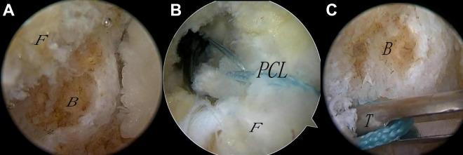 https://cdn.ncbi.nlm.nih.gov/pmc/blobs/59d9/7450458/2dd72ccdd372/10.1177_2325967120944047-fig2.jpg
