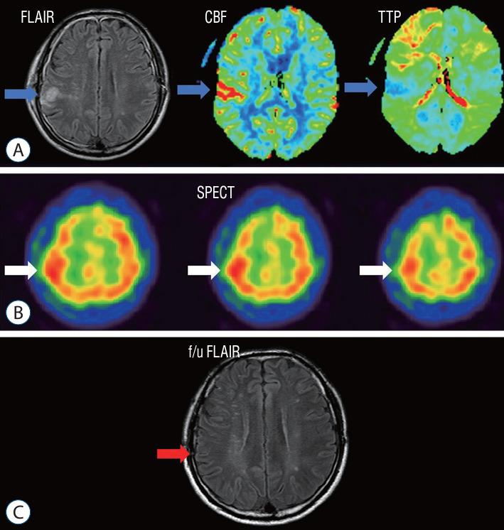 https://cdn.ncbi.nlm.nih.gov/pmc/blobs/59e0/11220419/d9df6cb73d0a/jkns-2023-0183f4.jpg