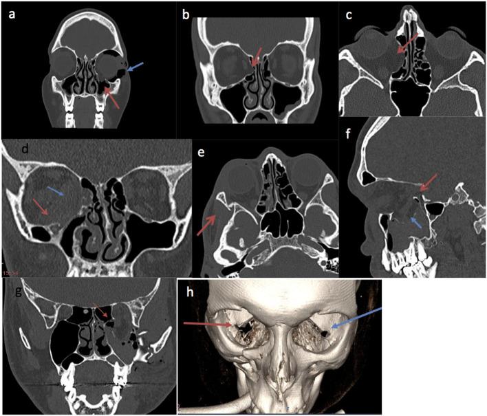 https://cdn.ncbi.nlm.nih.gov/pmc/blobs/5a23/8353087/26b85adba2cf/fsurg-08-693607-g0001.jpg