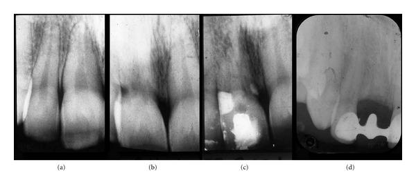 https://cdn.ncbi.nlm.nih.gov/pmc/blobs/5a40/3477661/28ce92f01638/CRIM.DENTISTRY2012-693240.004.jpg