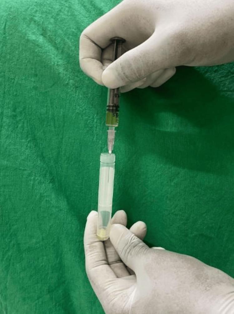 https://cdn.ncbi.nlm.nih.gov/pmc/blobs/5a56/12180776/8f7f77d35f64/cureus-0017-00000084559-i02.jpg
