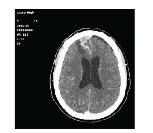 https://cdn.ncbi.nlm.nih.gov/pmc/blobs/5a6e/3423776/79fc73d70640/CRIM.SURGERY2012-614321.002.jpg