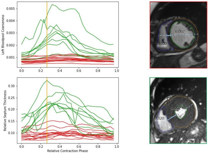 https://cdn.ncbi.nlm.nih.gov/pmc/blobs/5a7e/8960112/b6b4fee726f6/fcvm-09-829512-g0008.jpg