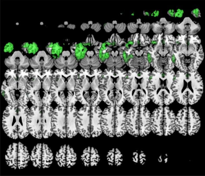 https://cdn.ncbi.nlm.nih.gov/pmc/blobs/5aee/6079194/cef13629c760/fnagi-10-00230-g0007.jpg