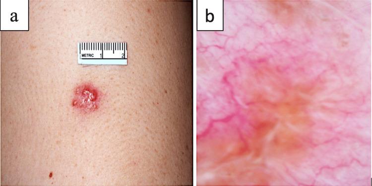 https://cdn.ncbi.nlm.nih.gov/pmc/blobs/5b4b/10494871/6dc1c49fb4ee/cureus-0015-00000043374-i01.jpg
