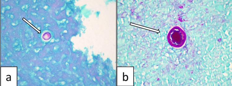 https://cdn.ncbi.nlm.nih.gov/pmc/blobs/5b4b/10494871/965cf5c1036b/cureus-0015-00000043374-i03.jpg