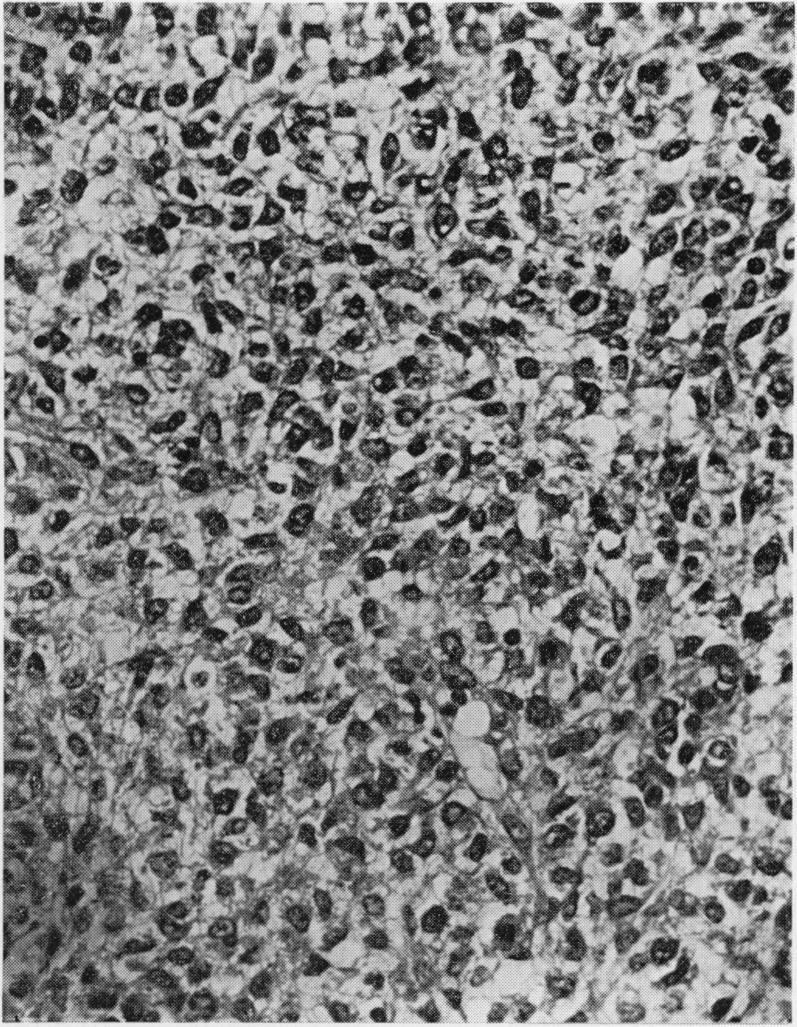 https://cdn.ncbi.nlm.nih.gov/pmc/blobs/5b4f/2025579/4aeca2313544/brjcancer00297-0044-b.jpg
