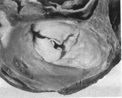https://cdn.ncbi.nlm.nih.gov/pmc/blobs/5bb3/483431/5e98354c0893/brheartj00219-0007-b.jpg
