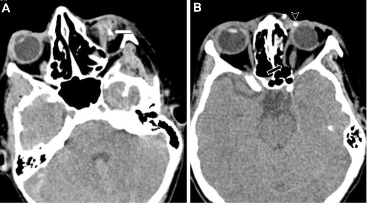 https://cdn.ncbi.nlm.nih.gov/pmc/blobs/5bc6/7196204/00e512730c5d/OPTH-14-1145-g0004.jpg