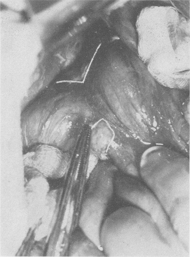 https://cdn.ncbi.nlm.nih.gov/pmc/blobs/5c7c/1451054/e42e18ee8fa5/annsurg01238-0117-a.jpg