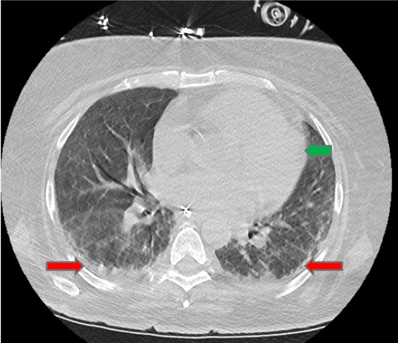 https://cdn.ncbi.nlm.nih.gov/pmc/blobs/5c98/6695237/0206e95ccae2/cureus-0011-00000004932-i04.jpg
