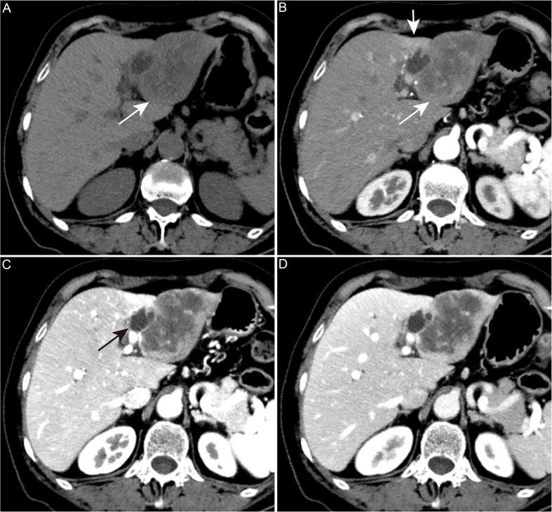 https://cdn.ncbi.nlm.nih.gov/pmc/blobs/5d71/12134910/559c407db5bf/JCTH-13-504-g003.jpg
