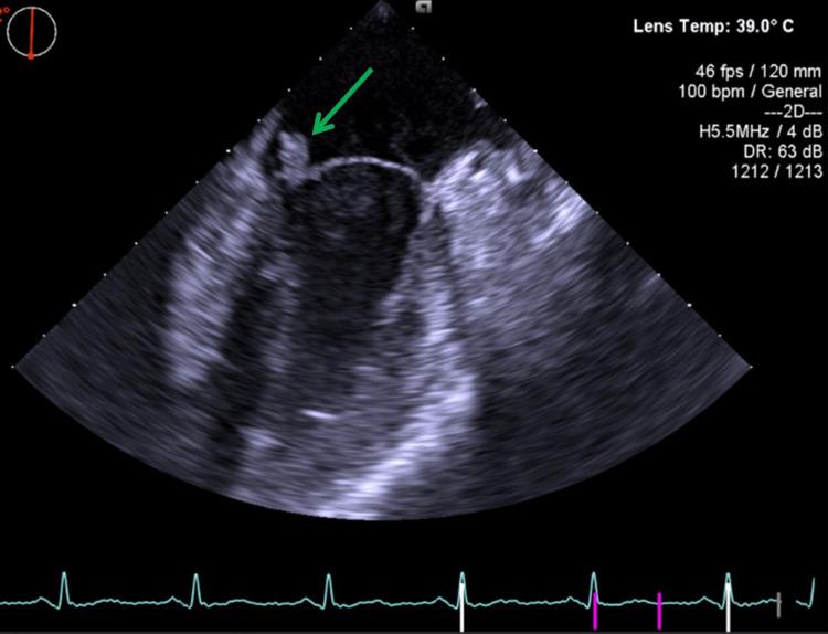 https://cdn.ncbi.nlm.nih.gov/pmc/blobs/5e3d/12187033/79974069679b/cureus-0017-00000084782-i04.jpg