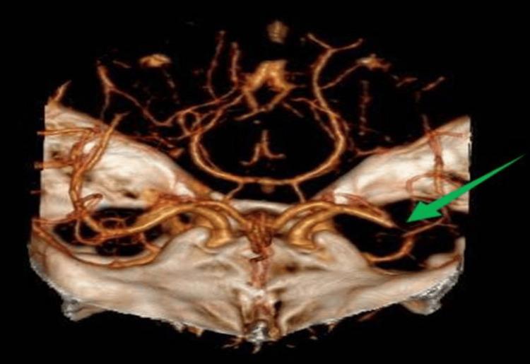 https://cdn.ncbi.nlm.nih.gov/pmc/blobs/5e3d/12187033/a9fd0e6810e4/cureus-0017-00000084782-i01.jpg