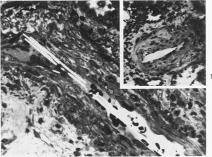 https://cdn.ncbi.nlm.nih.gov/pmc/blobs/5e56/1912470/5991a767323b/amjpathol00465-0107-a.jpg