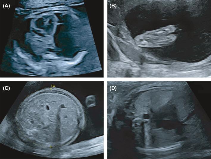 https://cdn.ncbi.nlm.nih.gov/pmc/blobs/5e5f/8353418/2bb49c986693/CCR3-9-e04624-g002.jpg