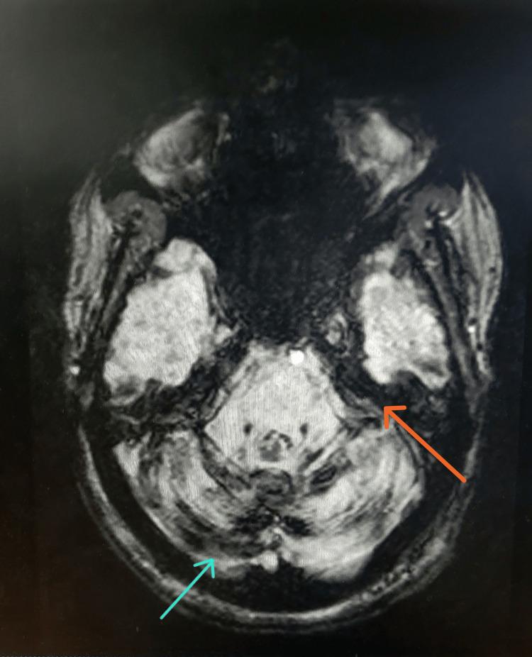 https://cdn.ncbi.nlm.nih.gov/pmc/blobs/5e68/12395121/c3876c49d66a/cureus-0017-00000089025-i01.jpg
