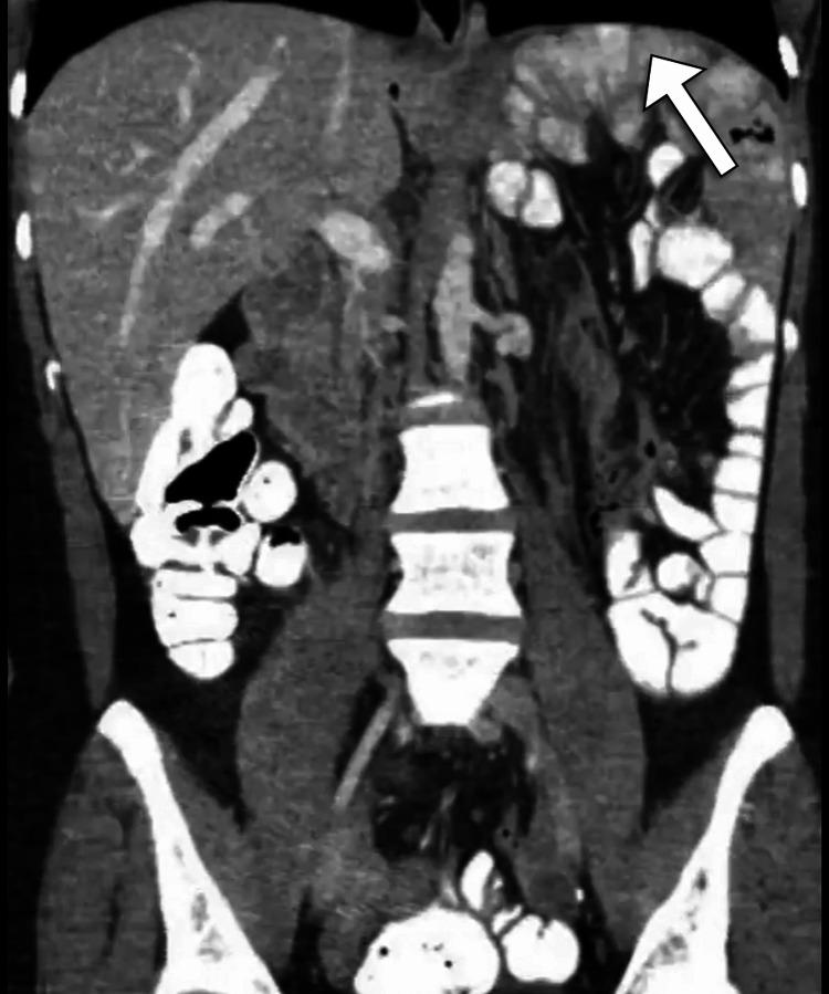 https://cdn.ncbi.nlm.nih.gov/pmc/blobs/5e6a/9890613/8a784bed125d/cureus-0015-00000033246-i01.jpg