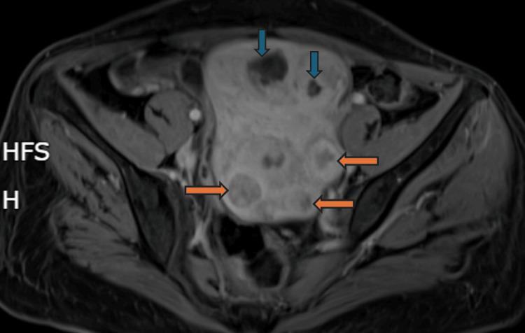 https://cdn.ncbi.nlm.nih.gov/pmc/blobs/5e8d/11347960/adc58498c387/cureus-0016-00000067887-i03.jpg