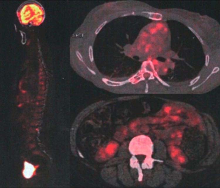 https://cdn.ncbi.nlm.nih.gov/pmc/blobs/5e8d/11347960/fd83e0859a0b/cureus-0016-00000067887-i04.jpg