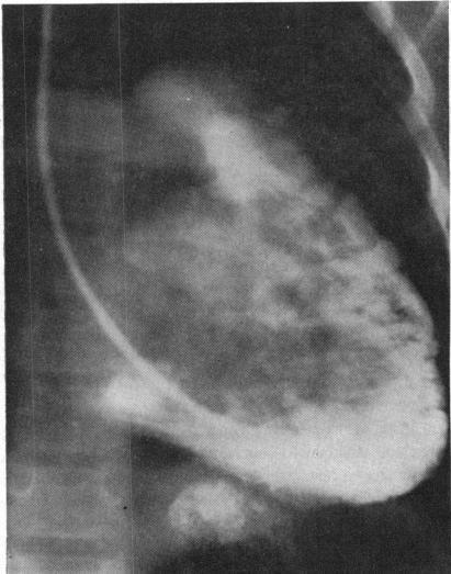 https://cdn.ncbi.nlm.nih.gov/pmc/blobs/5ea9/487830/a3e325afb28b/brheartj00327-0085-a.jpg