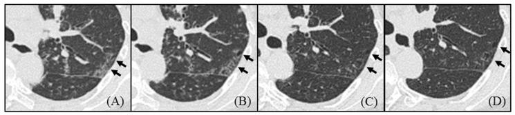 https://cdn.ncbi.nlm.nih.gov/pmc/blobs/5ec9/10135672/47150dbdede7/arm-91-00014-g005.jpg