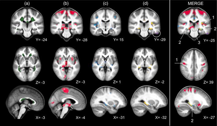 https://cdn.ncbi.nlm.nih.gov/pmc/blobs/5f39/7856642/046a07e86500/HBM-42-1003-g002.jpg