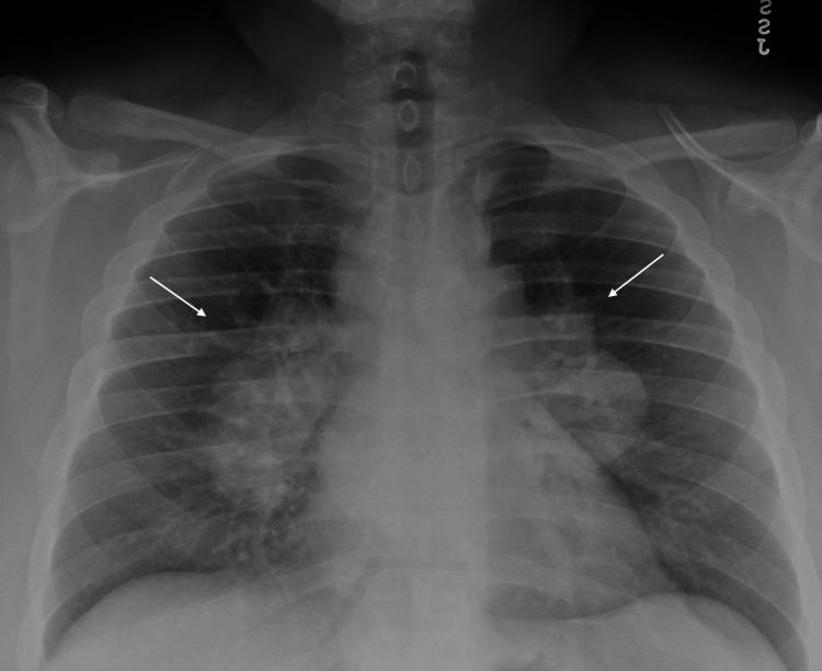 https://cdn.ncbi.nlm.nih.gov/pmc/blobs/5f3e/9948513/0ad427e1344f/cureus-0015-00000034135-i01.jpg